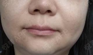 做去眼袋手术多少钱 做去眼袋手术多少钱